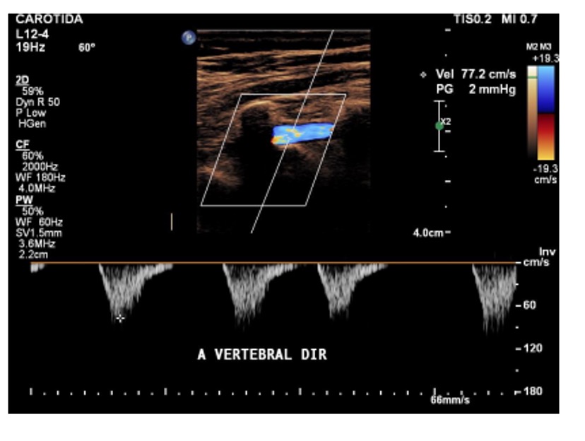Doppler espectral (PW) da artéria vertebral direita mostrando fluxo invertido, compatível com roubo completo