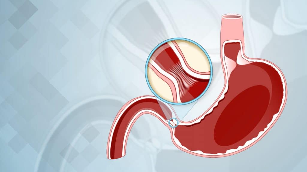 Ilustra&ccedil;&atilde;o demonstrando a estenose de piloro