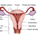 Sinéquias uterinas: saiba mais sobre diagnóstico e indicações de tratamento