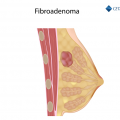 Ilustração de mama com fibroadenoma