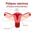 Diagrama de pólipos endocervicais