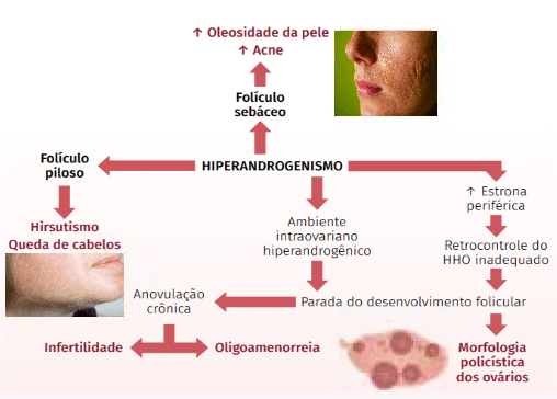 Diagrama esquem&aacute;tico ilustrando a fisiopatologia do hiperandrogenismo e sua rela&ccedil;&atilde;o com caracter&iacute;sticas da s&iacute;ndrome do ov&aacute;rio polic&iacute;stico (SOP). O diagrama apresenta o impacto do hiperandrogenismo em diferentes sistemas e sintomas, como oleosidade da pele, acne, hirsutismo, queda de cabelo, infertilidade, oligomenorreia e a morfologia polic&iacute;stica dos ov&aacute;rios.