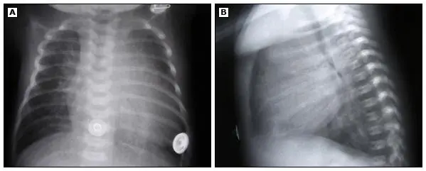 Imagem da radiografia de tórax mostrando coarctação crítica da aorta e insuficiência cardíaca em uma criança