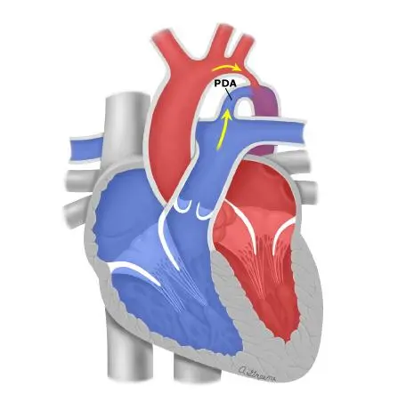 Imagem ilustrativa de coarctação crítica da aorta