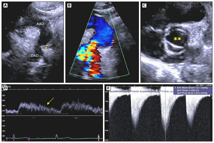 Imagens ecocardiográficas transtorácicas (ETT) com avaliação Doppler em paciente com coarctação de aorta