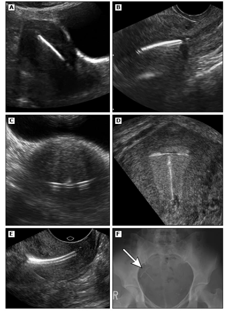 Ultrassonografias de dispositivos intrauterinos - Posição Normal e Anormal