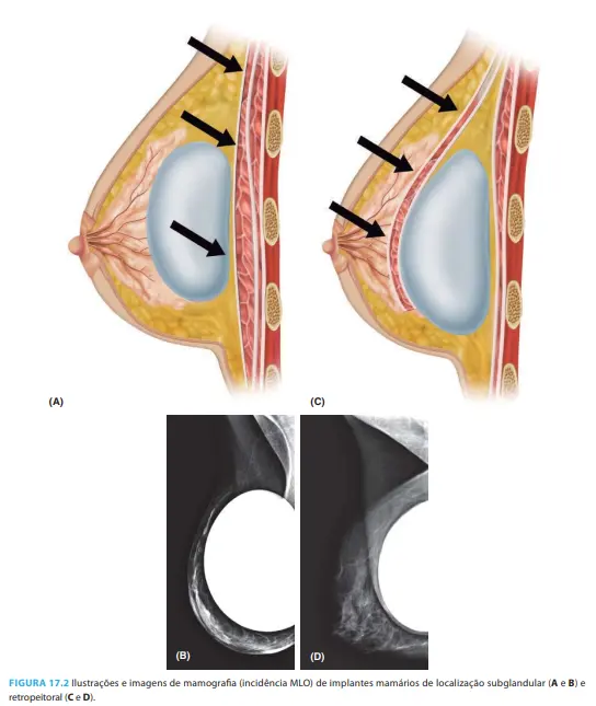 Ilustração de Ressonância Magnética mostrando o posicionamento de próteses mamárias