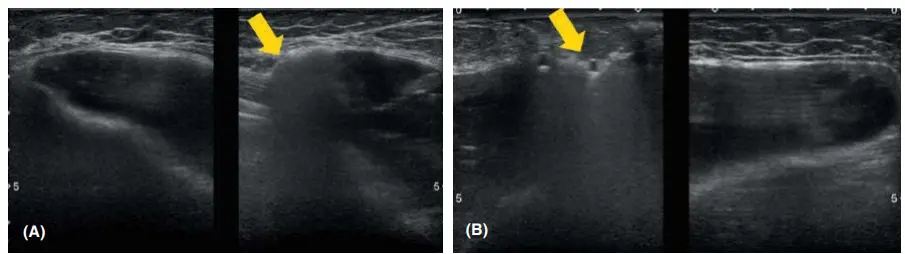 Imagem de ultrassonografia revelando prótese mamária extracapsular