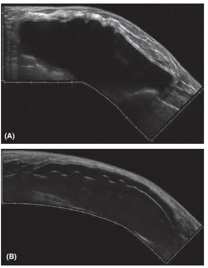 Imagem de ultrassonografia da mama mostrando prótese mamária intacta