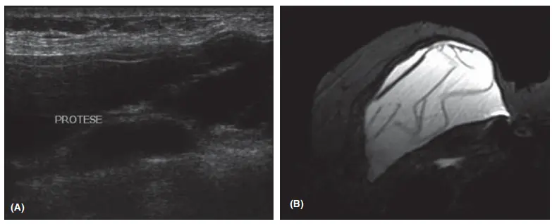 Imagem de Ultrassonografia e Ressonância Magnética mostrando ruptura intracapsular de prótese mamária
