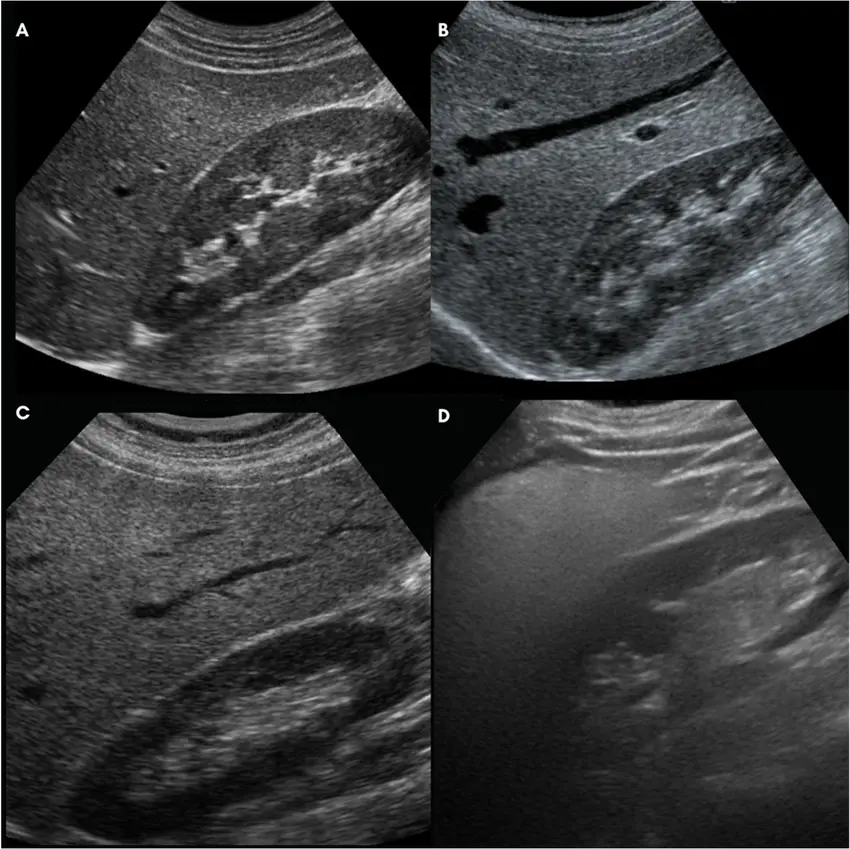 Imagem da classificação ultrassonográfica da esteatose hepática.
