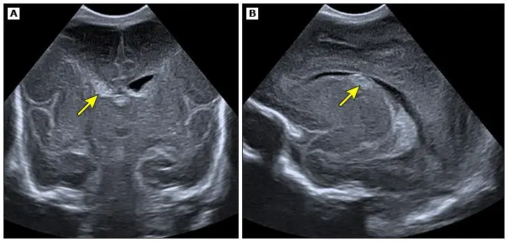 Imagem ilustrativa da ultrassonografia de um bebê prematuro com hemorragia peri-intraventricular grau I. 