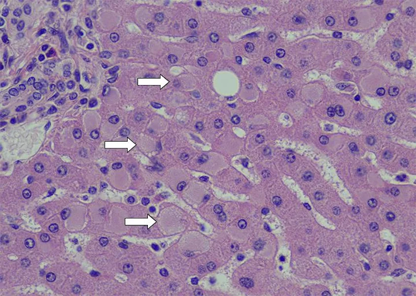 Imagem da biópsia hepática de um paciente com infecção crônica pelo vírus da hepatite B, destacando hepatócitos em vidro fosco.