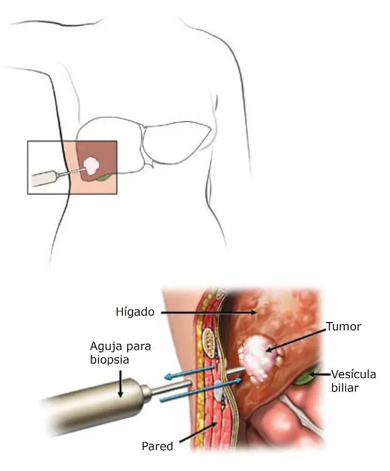 Imagem representativa da biópsia hepática, um método essencial para analisar tecidos do fígado e diagnosticar doenças hepáticas, destacando a importância do exame médico no campo da saúde hepática.