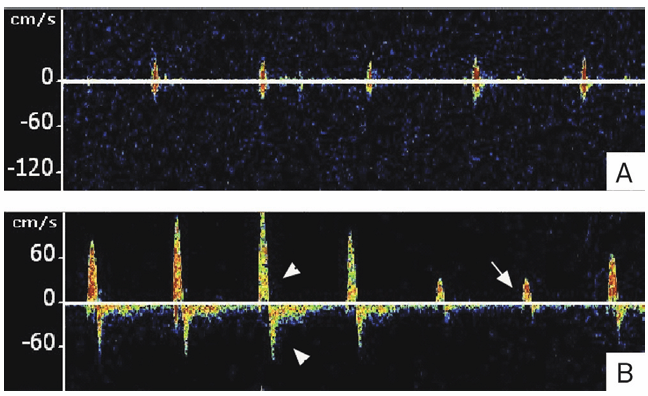 A imagem mostra um exame de Doppler transcraniano que monitora uma artéria cerebral média. Pico sistólico curto, fluxo alternante, anterógrado na sístole e reverso na diástole.