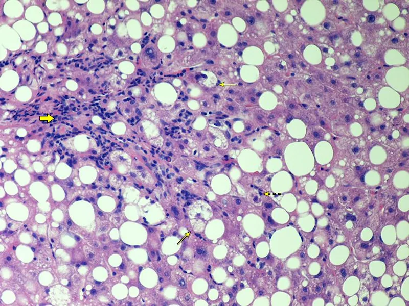 Imagem representativa da Esteato-Hepatite Não Alcoólica (NASH), uma condição hepática.