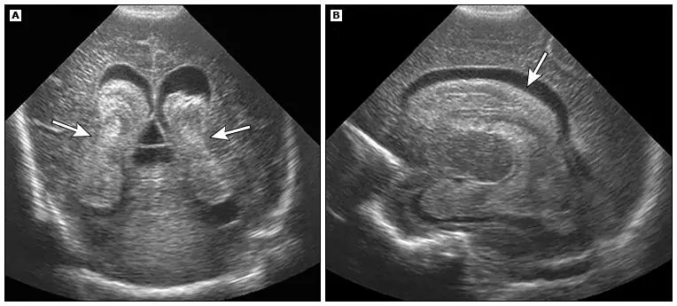 Imagem representativa da Hemorragia Peri-intraventricular em bebê de 29 semanas, grau III: Exploração dos impactos e estratégias de tratamento.