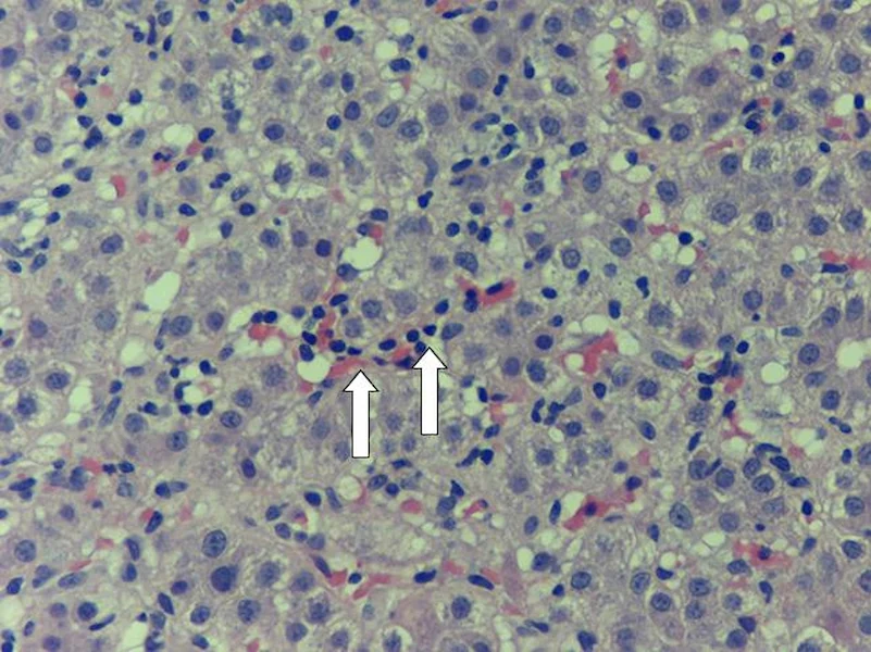 Imagem representativa da Hepatite por Vírus Epstein-Barr, uma doença hepática, com destaque para as informações essenciais sobre causas, sintomas e tratamentos.