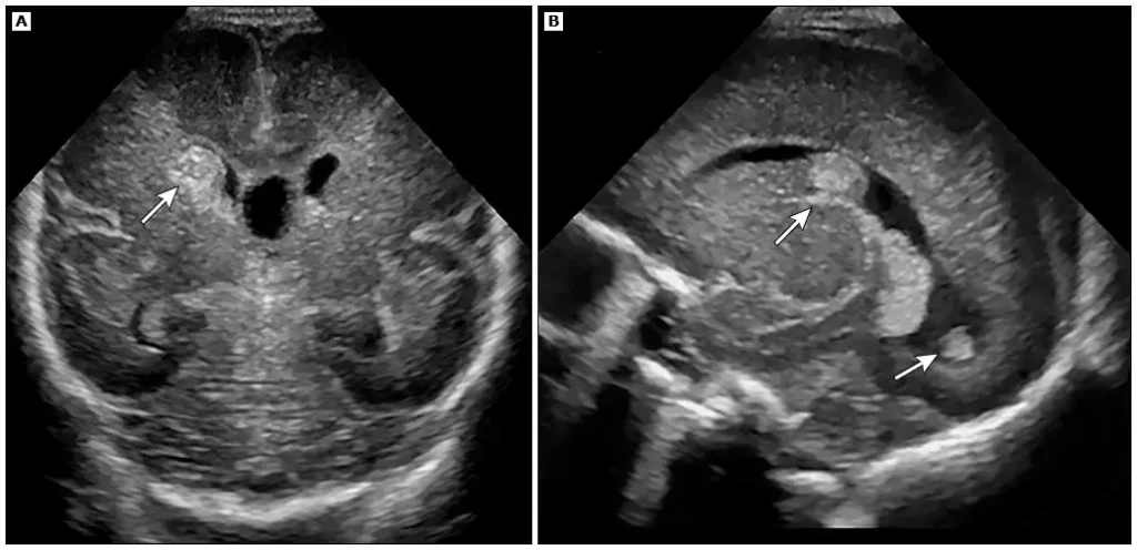 Imagem representativa do ultrassom para diagnosticar Hemorragia Peri-intraventricular (HPIV) Grau II em recém-nascidos de 28 semanas. 
