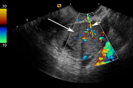 Imagem de ultrassonografia transvaginal Doppler demonstrando fluxo sanguíneo na porção sólida da massa ovariana.