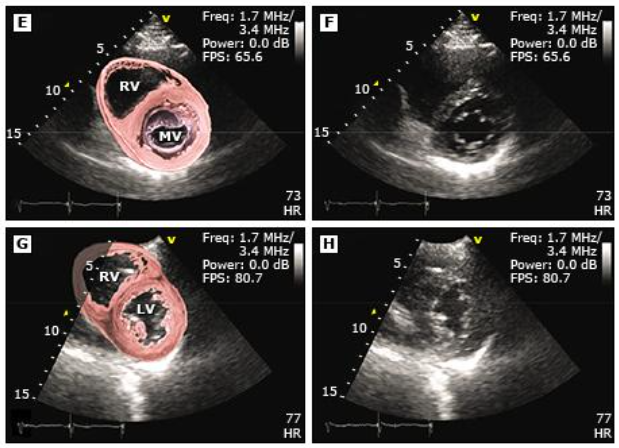 Posição do transdutor ecocardiográfico transtorácico paraesternal para otimizar o diagnóstico por imagens ecocardiográficas.