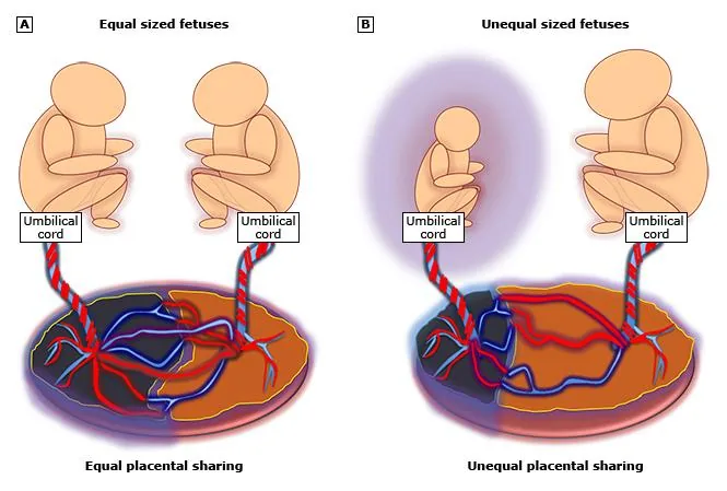 Imagem representativa da pesquisa sobre Restrição de Crescimento Fetal Seletiva