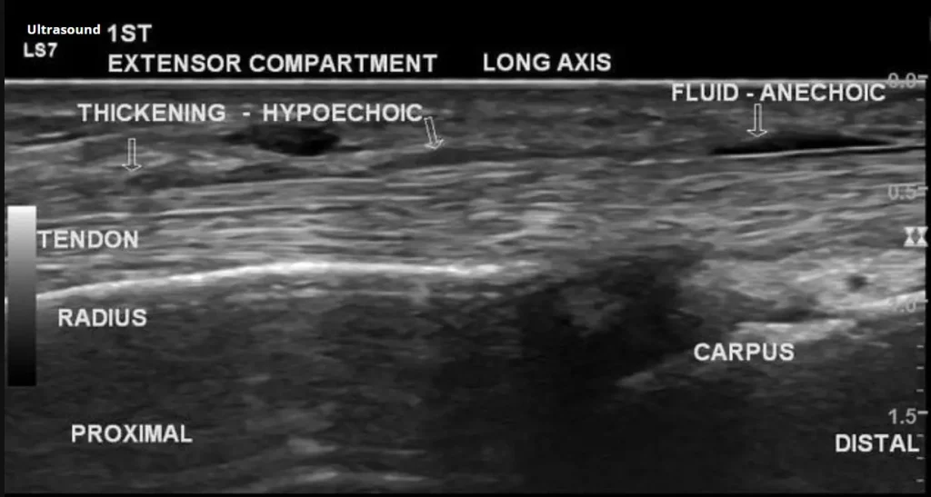 Imagem de Ultrassonografia (USG) para diagnóstico de Tenossinovite de Quervain
