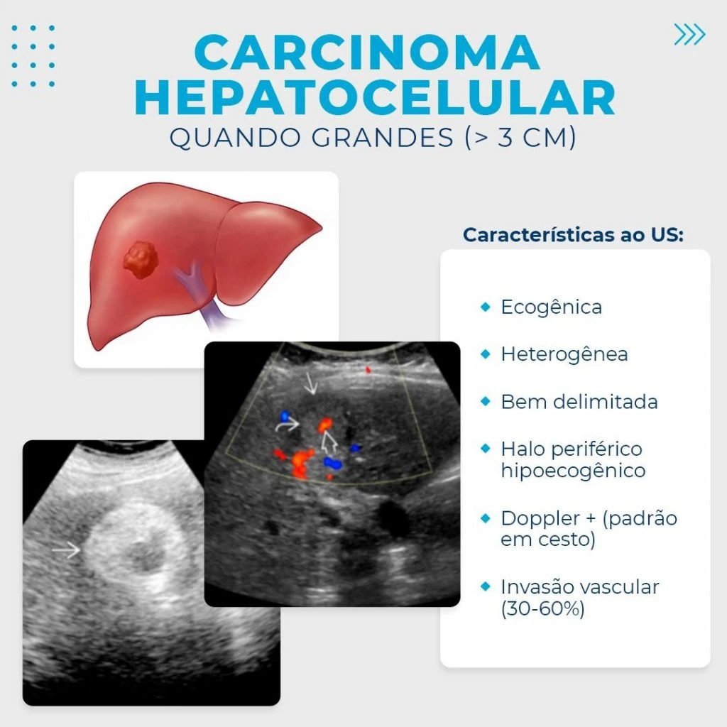Imagem com esquema gráfico para explicar o carcinoma hepatocelular visto pela ultrassonografia quando grandes, sendo maiores do que 3 centímetros.