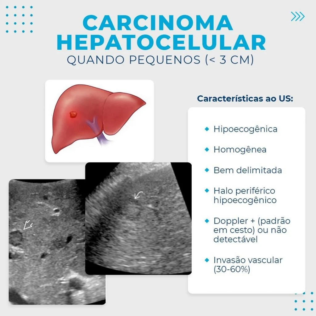 Imagem com esquema gráfico para explicar o carcinoma hepatocelular visto pela ultrassonografia quando pequenos, sendo menores do que 3 centímetros.