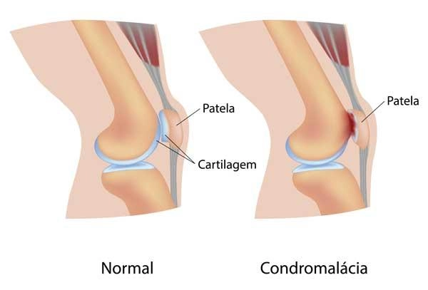 Imagem para indicar como a condromalácia patelar afeta a cartilagem na superfície superior da patela (rótula).