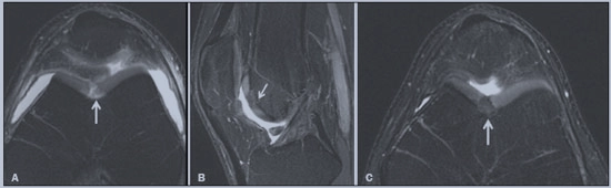 Imagem de exame de ressonância magnética para apontar a diferença entre a lesão condral profunda no pré-operatório e no pós-operatório.
