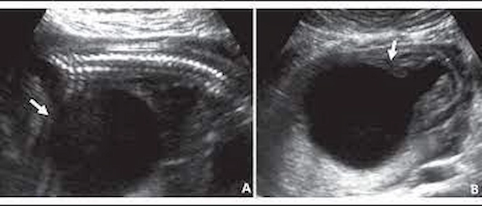 Imagem para ilustrar o keyhole sign ou buraco de fechadura no exame de ultrassom, um sinal frequente de megabexiga fetal.