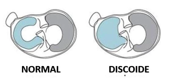 Imagem para comparar um menisco normal de um menisco discoide.