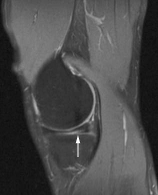 Imagem de ressonância magnética indicando ruptura oblíqua de menisco medial.