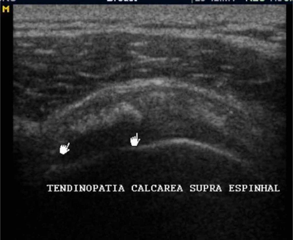 Imagem de ultrassonografia para mostrar como é uma tendinopatia calcária na calcificação (fase III).