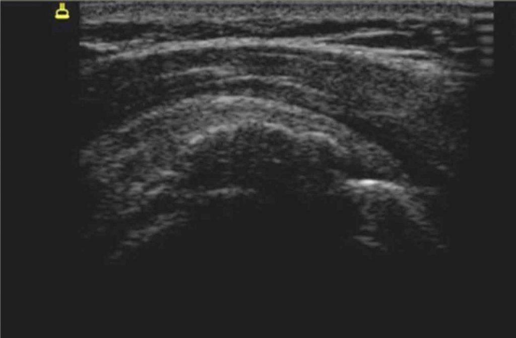 Imagem de ultrassonografia para mostrar como é uma tendinopatia calcária na formação de calcificação (fase II).