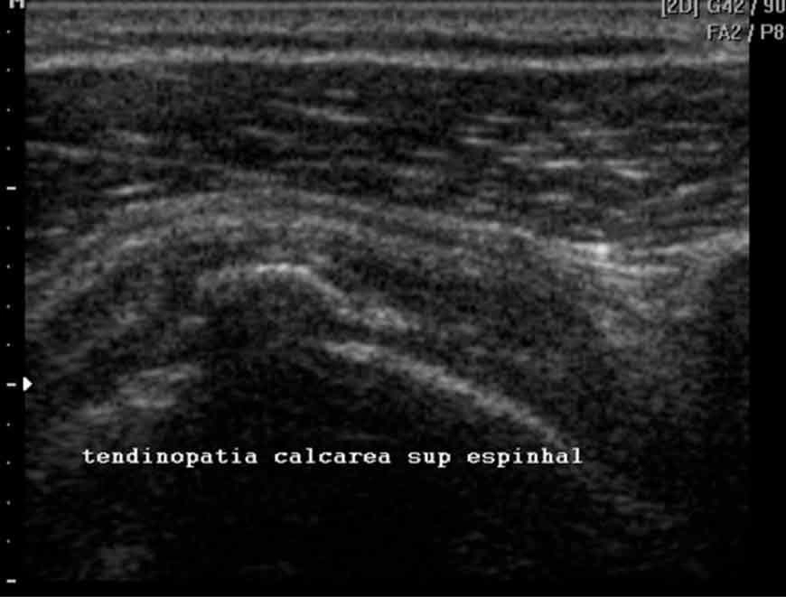 Imagem de ultrassonografia para mostrar como é uma tendinopatia calcária na pré-calcificação (fase I).