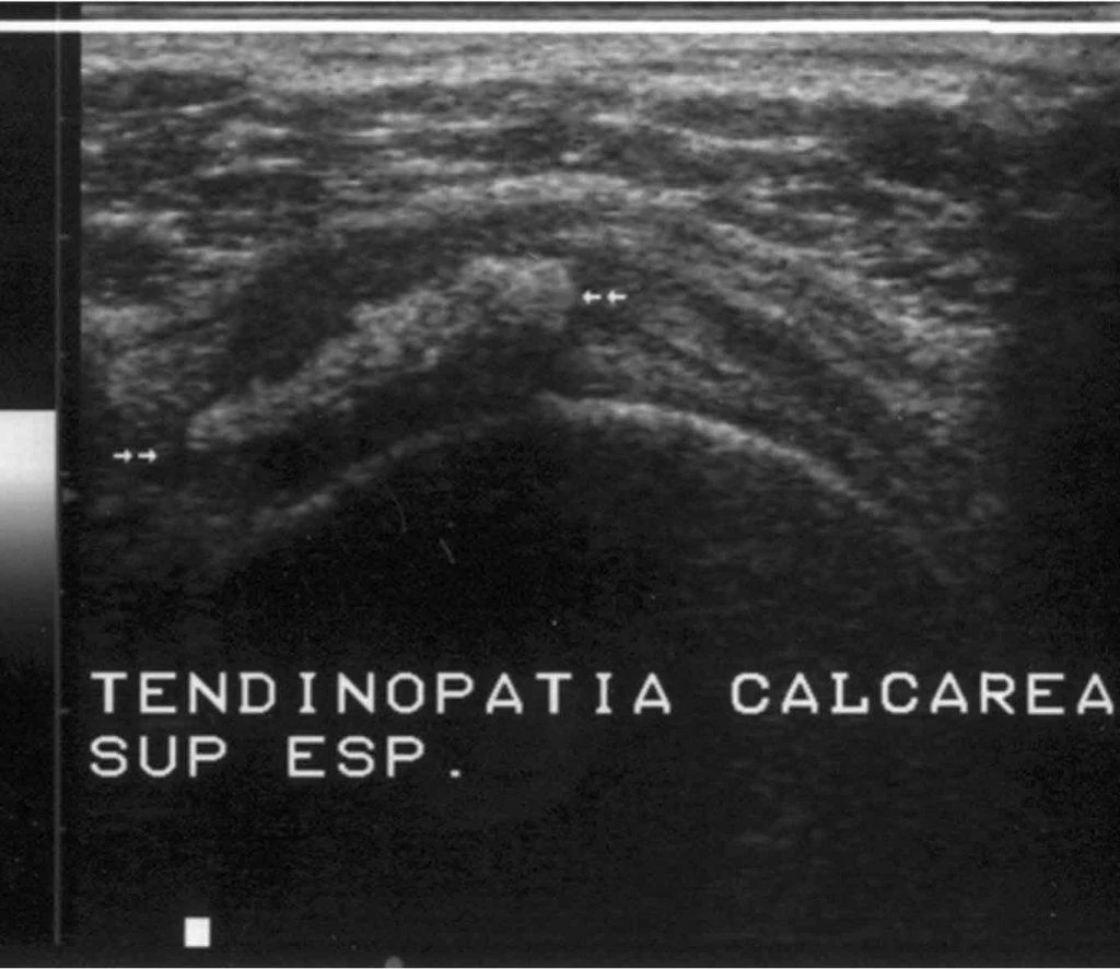 Imagem de ultrassonografia para mostrar como é uma tendinopatia calcária na reabsorção (fase IV).
