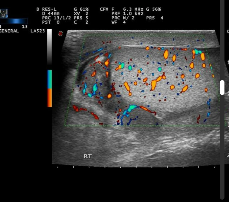 Imagem de exame de ultrassonografia revelando aumento do epidídimo.