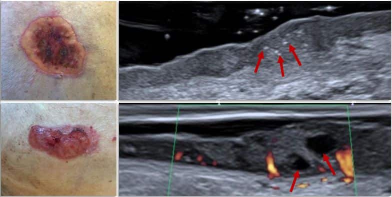 Correlação entre imagem clínica e ultrassonografia de lesões cutâneas ulceradas com vascularização aumentada observada no Doppler colorido.