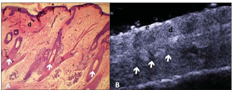 Comparação histológica (A) e ultrassonográfica (B) da pele com glândulas e estruturas dérmicas marcadas por setas brancas; destaque para camadas epidérmica (e) e dérmica (d).