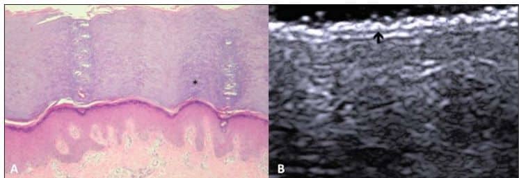 Comparação entre histologia (A) e ultrassom (B) de pele com espessamento epidérmico e dérmico, indicando lesão inflamatória marcada por asterisco e seta.