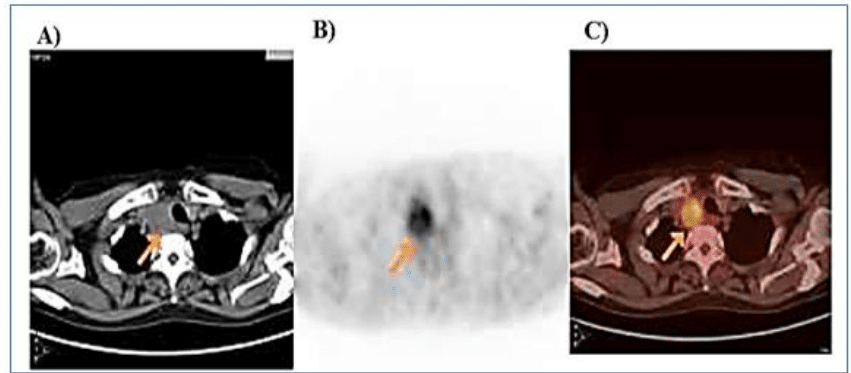 PET-CT no estadiamento inicial do câncer