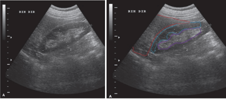 ultrassonografia do rim direito