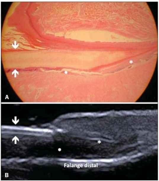 Comparação entre histologia (A) e ultrassonografia (B) da unidade ungueal, com destaque para a lâmina ungueal (setas), matriz (ponto), leito ungueal (asterisco) e falange distal.