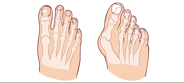 Ilustra&ccedil;&atilde;o comparativa entre um p&eacute; normal e um com h&aacute;lux valgo (joanete), evidenciando o desvio lateral do dedo grande e a proemin&ecirc;ncia &oacute;ssea na base do h&aacute;lux.