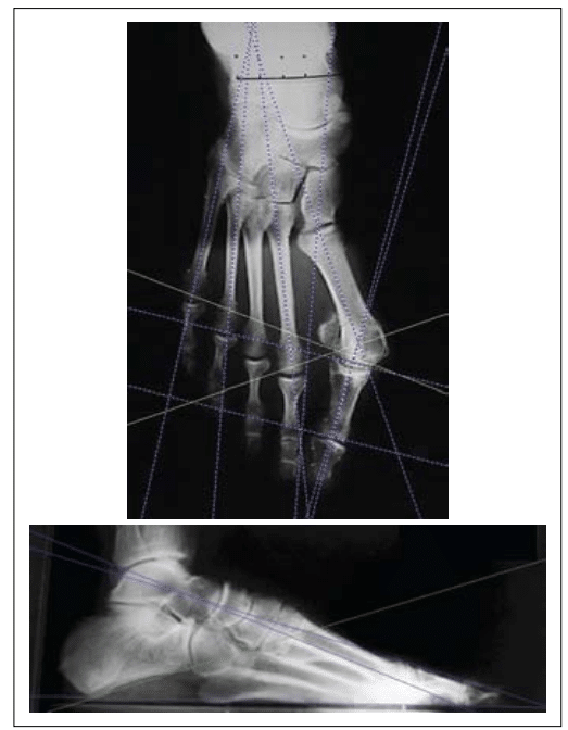 Radiografias do p&eacute; com proje&ccedil;&otilde;es dorsoplantar e lateral, apresentando marca&ccedil;&otilde;es geom&eacute;tricas utilizadas para avalia&ccedil;&atilde;o do &acirc;ngulo do h&aacute;lux valgo e alinhamento &oacute;sseo.