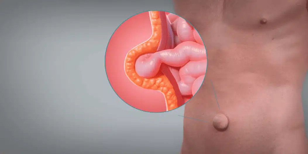 h&eacute;rnia umbilical