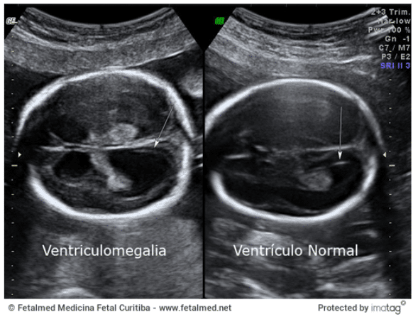 Comparativo de ultrassom transventricular demonstrando ventriculomegalia fetal &agrave; esquerda e ventr&iacute;culo lateral normal &agrave; direita, essencial para diagn&oacute;stico pr&eacute;-natal de hidrocefalia.