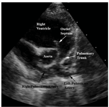 Ecocardiografia fetal mostrando estruturas card&iacute;acas como ventr&iacute;culo direito, tronco pulmonar, art&eacute;rias pulmonares e aorta, importante na triagem de cardiopatias cong&ecirc;nitas.